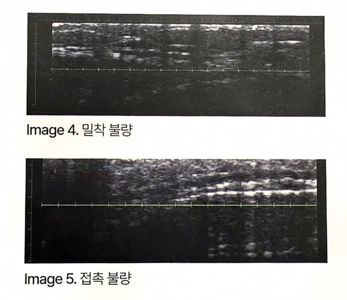 초음파 화면 비교. 위는 밀착이 불량한 경우, 아래는 접촉이 불량한 경우