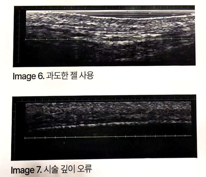 초음파 화면 비교. 위는 젤을 과도하게 쓴 경우, 아래는 시술 깊이가 어긋난 경우